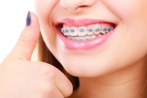 Girl with traditional metal braces