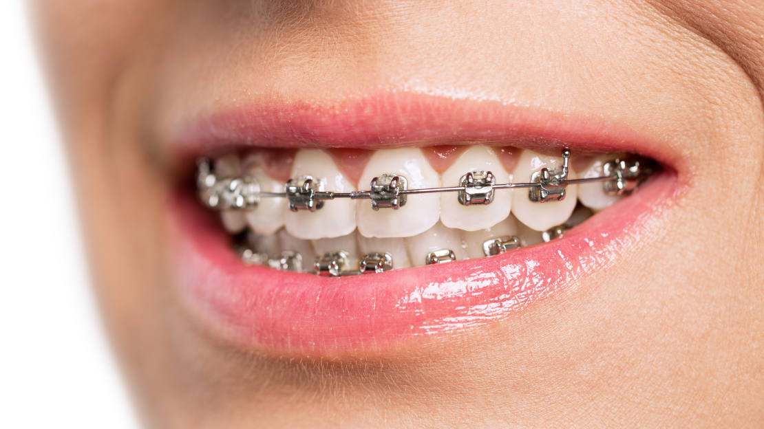 Close-up of mouth smiling with metal braces and pink lips