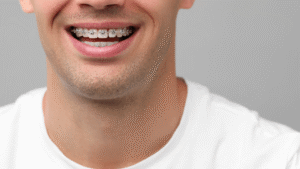 Close-up of a smiling man with metal braces on his upper teeth