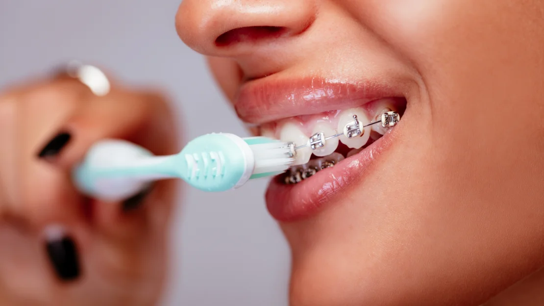 Braces Care: Tips for Maintaining Oral Hygiene During Treatment 1