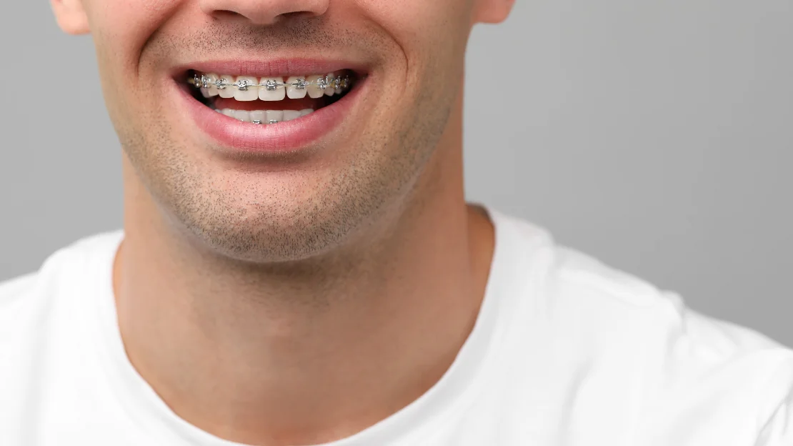 Braces for Adults: Discreet Options, Quick Results, and Why It's Never Too Late 1
