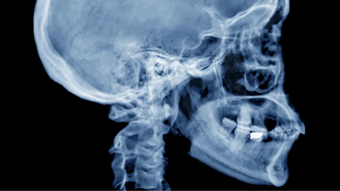 Lateral cephalometric x-ray of a human skull and jaw